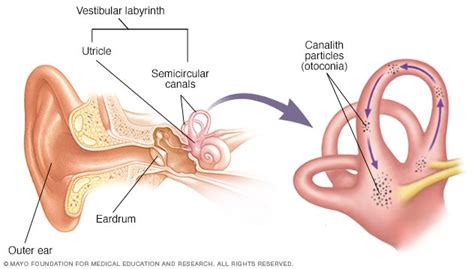 Benign paroxysmal positional vertigo (BPPV) - Diagnosis and treatment ...