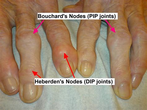 Osteoarthritis Stages