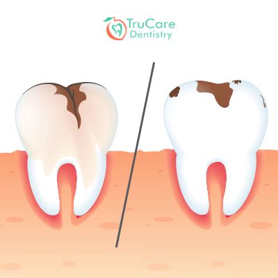 Cavity vs. Stain: Everything You Should Know – TruCare Dentistry