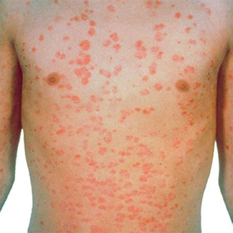 Guttate Psoriasis - Causes, Symptoms, Treatment, Diet & Home Remedy