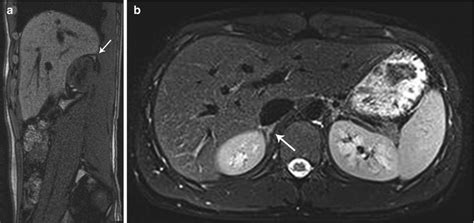 Adrenal Gland Imaging | Radiology Key