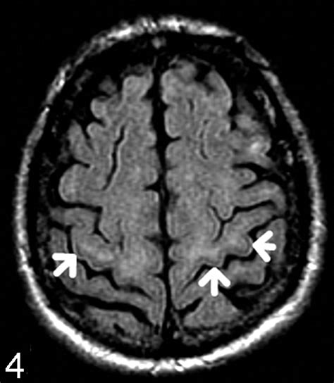 Postcentral Gyrus Mri