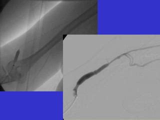 Haemodialysis Fistula Intervention - Dr Ralph Jackson.ppt