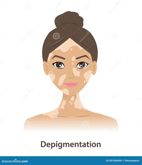 Hypopigmentation On Face