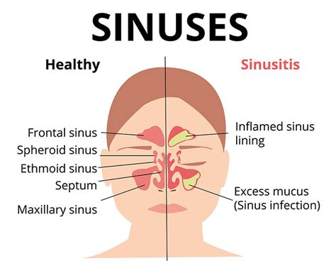 What Causes Swollen Nasal Passages