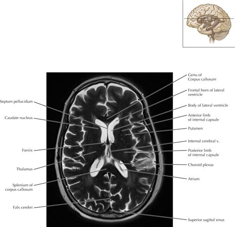 Ventricles Of The Brain Mri