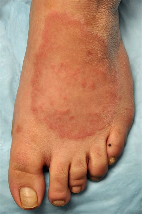 Hyperlipidemia and Skin Disease - GK Dermatology, PC