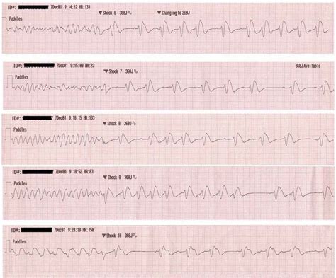 Ventricular Tachycardia Ecg