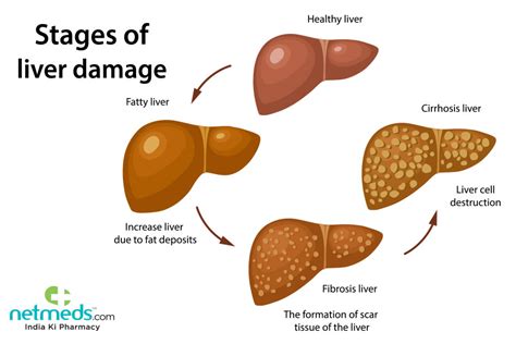 Alcoholic Liver Cirrhosis Treatment