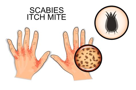 Scabies : Overview, Causes, Symptoms, Treatment - illness.com