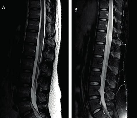 (A) Lumbosacral spine MRI without contrast. (B) Resonance showing sign ...