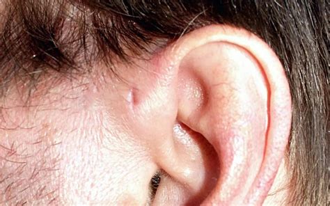 Flipboard: Hole in ear (preauricular pit): What to know