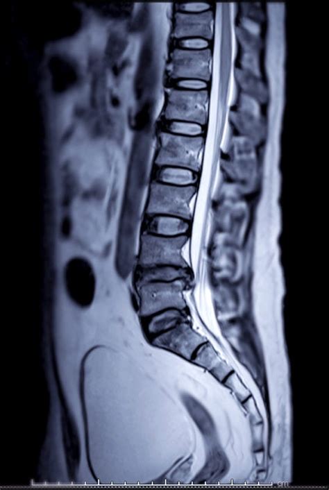 Spine MRI Results and Medical Decision Making: Get All Your Options