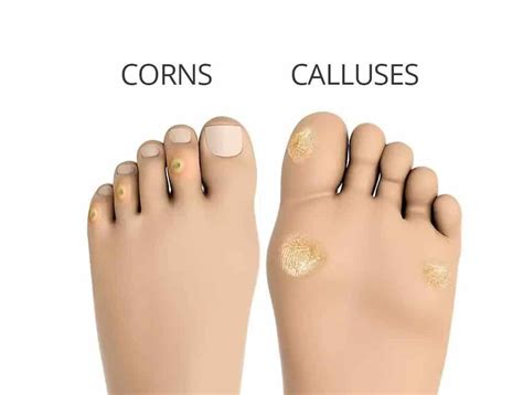 What is Corns and Calluses: Types, Symptoms, and Causes ...