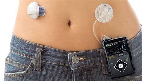 Diabetes Insulin Pump - How Insulin Pump Work, Pros & Cons