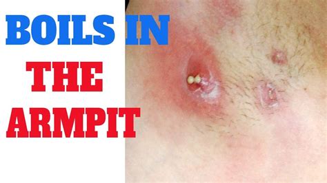 Boil in armpit | Symptoms of boil in armpit | Arm pit pus | Underarm ...