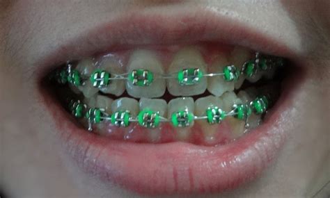 Viewing Gallery For - Neon Braces Colors | Braces colors, Braces bands ...