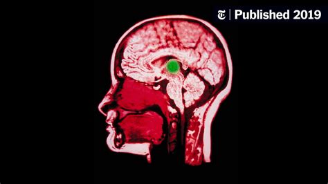 Groundbreaking brain implant offers hope for traumatic brain injury ...