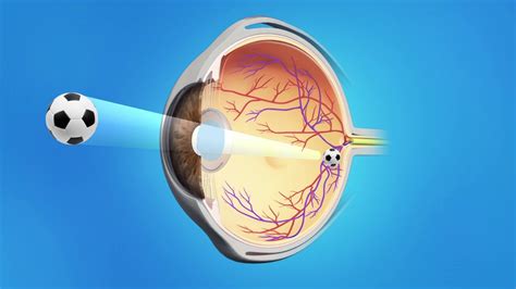 Cataract surgery toric lens