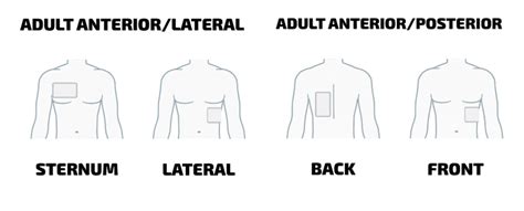 Optimum method for defibrillation Pad Placement - Intelesens