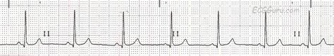 ECG Basics: Normal Sinus Rhythm | ECG Guru - Instructor Resources