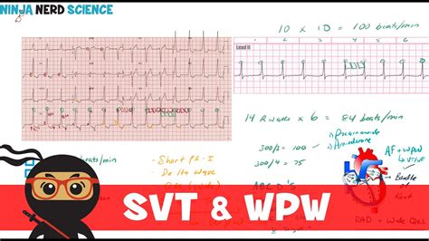 Rate and Rhythm | Supraventricular Tachycardia (SVT) and Wolff ...