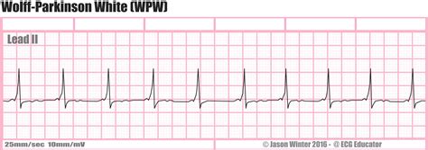 ECG Educator Blog : Wolff-Parkinson-White