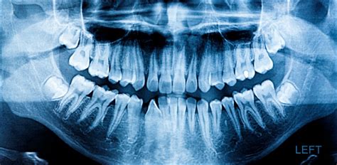 Oral & Dental X-Rays, Xrays Of Teeth Burlington | Britannia Dental Centre