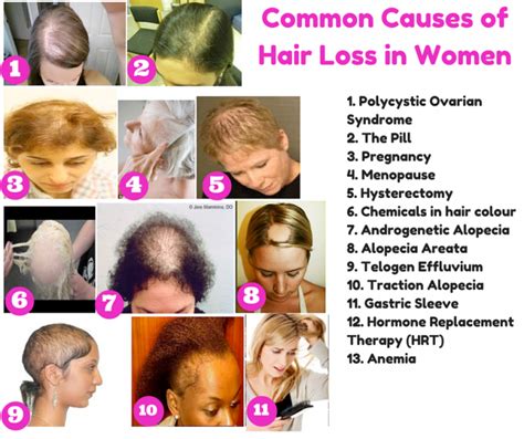 Reasons For Hair Loss In Young Women – The Crush Fashion