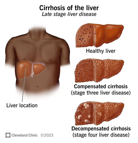 Understanding Cirrhosis: Causes, Symptoms, And Treatment - Ask The ...