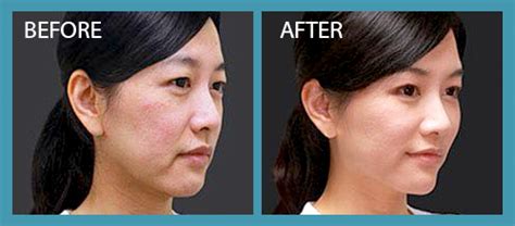 Ellanse filler: Anti Wrinkle Treatment | Premier Clinic | Malaysia