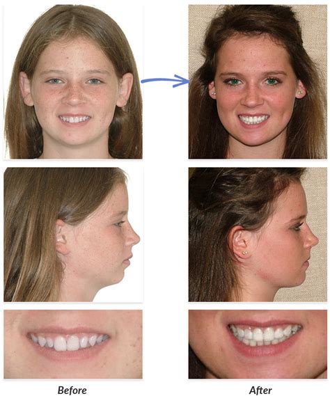 Before & After Braces Photos | DeLurgio Orthodontics : DeLurgio ...