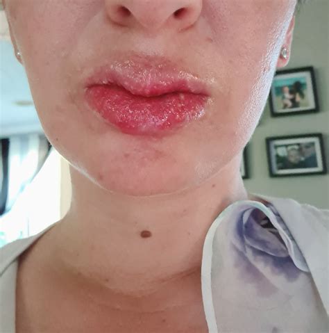 Please Help, Tiny Bumps/blisters On Lips Day 15 Of Accutane ...