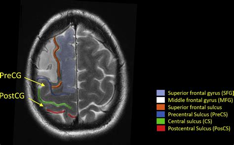 Superior Frontal Gyrus Mri