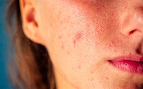 Acne Papules - Causes, Symptoms, Treatments – SkinKraft