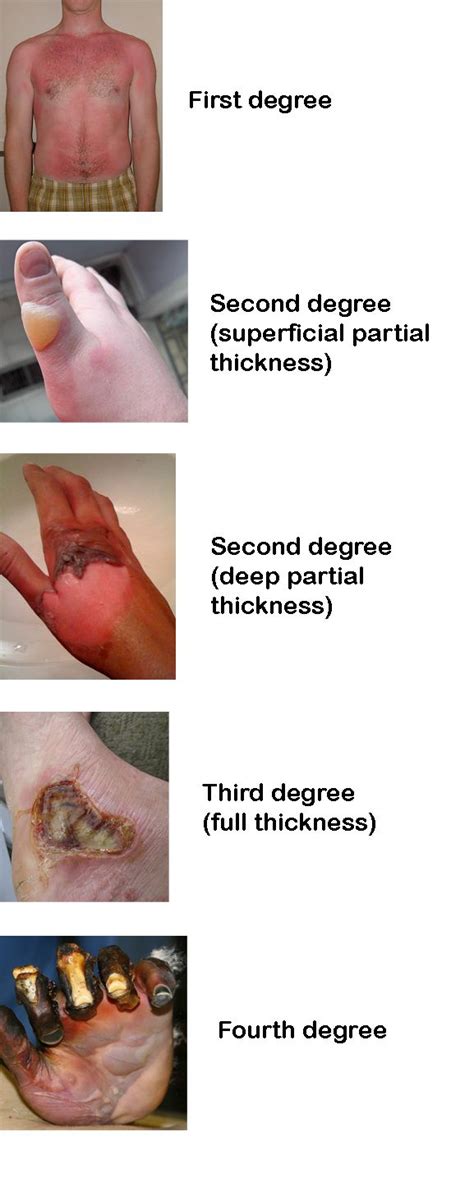 What causes second degree burns - realityress