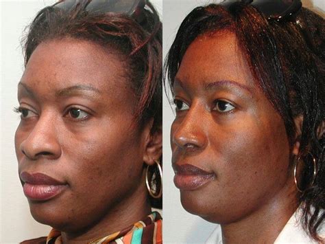 Best Looking Nose African American Nose » Rhinoplasty: Cost, Pics ...