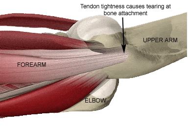 Forearm Tendon Tightness