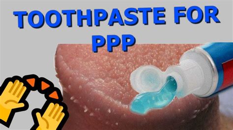 Pearly Penile Papules Removal With Toothpaste - YouTube