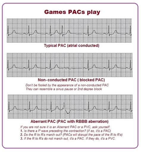 Premature Atrial Contraction Strip