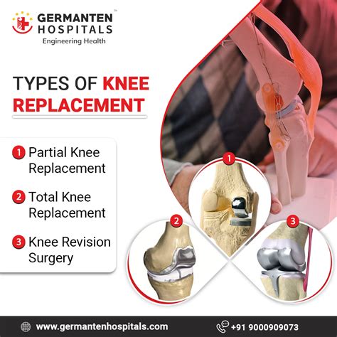 The Three main types of knee replacement surgery are: total knee ...