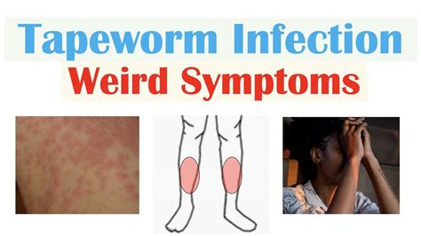 Weird Symptoms of Tapeworm Infection (Skin, Psychological, Neurological ...