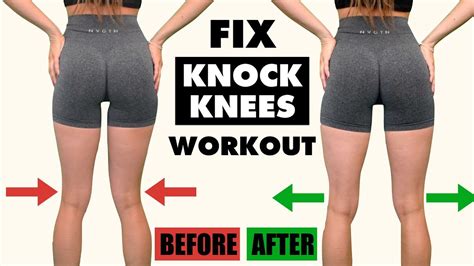 10 Min "Knock Knees" Home Workout | FIX Knock Knees in 10 Min/Day ...