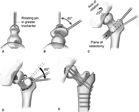 Femoral Head Osteonecrosis—Proximal Femoral Osteotomy and Open Bone ...