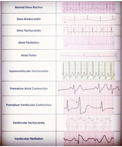 How To Read An Ekg Strip