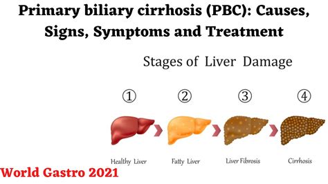 Primary biliary cirrhosis (PBC): Causes, Signs, Symptoms and Treatment