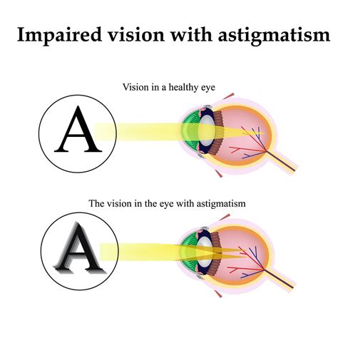 Toric Lens Implants and Astigmatism — Grosinger, Spigelman & Grey