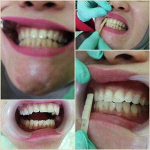 Memutihkan Gigi (Bleaching Teeth) - DokterGigi.ID