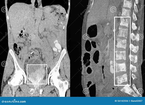 Prostate Cancer, Bone Metastases. CT-scan Reconstruction. Stock Photo ...