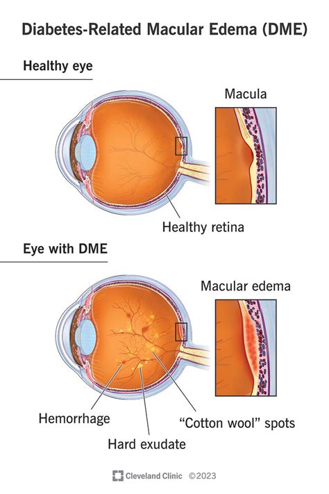 Retinal Hemorrhage Diagram